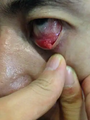 > 问题页   你好,这个考虑结膜息肉的可能,建议你至眼科随诊治疗