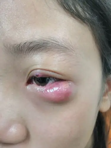 睑腺炎(俗称:麦粒肿,中医名:针眼)的个人经验治疗_麦粒肿 - 好大夫