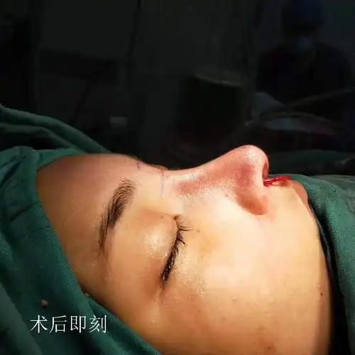 5,鼻小柱采用移植物延伸抬高,缩小两侧鼻翼.