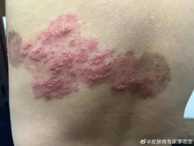 治带状疱疹的好方,不留后遗症!