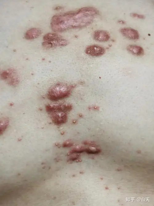 开个同位素敷贴治疗疤痕疙瘩的帖子持续更新各位朋友有治好的可以说下