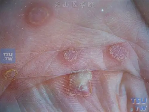 梅毒:硬下疳,二期黏膜损害症状表现〔慎入〕 - 皮肤病学 - 天山医学院