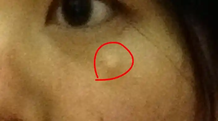 我妈的脸上有一个包,听她说从出生就有了,有必要割掉吗