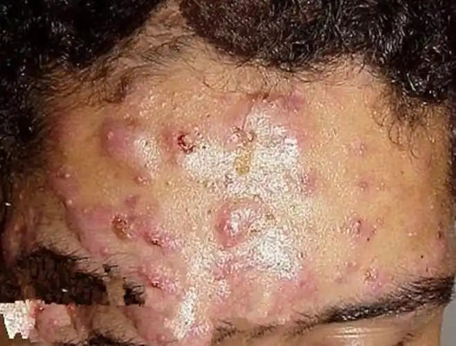 囊肿性痤疮对比图片