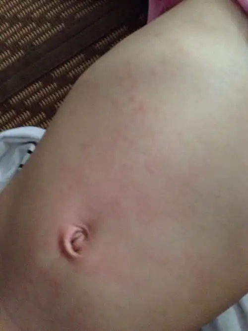 两岁宝宝身上长红点,瘙痒难受,这是啥症状?