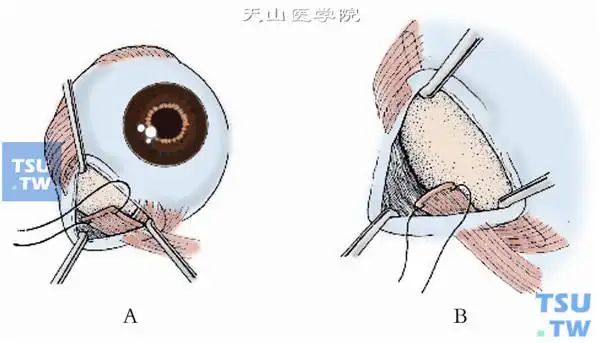 斜视手术:下斜肌前转位术操作及注意事项