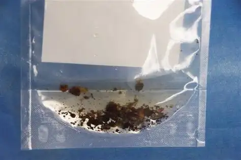 胆总管结石多为顽固的泥沙样结石