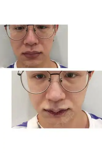 找到这家医美让医生为我设计怎么做,最后聊下来确定了做m唇 上下唇改.