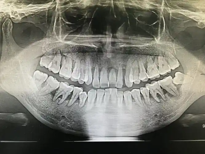 重度牙周病 - 好大夫在线