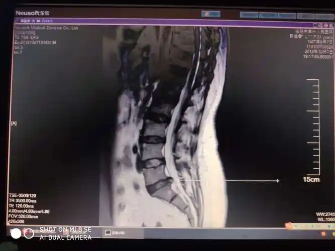 mri显示腰5骶1椎间盘脱出