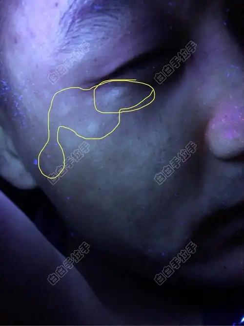 眼角的白斑刚刚去咨询了几位医生,又回到了恐惧之中!