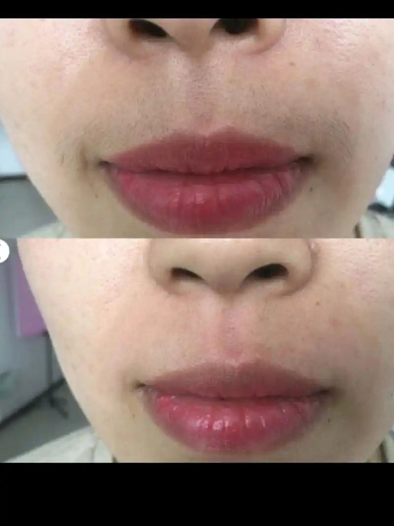 干货教程"脱唇毛"经历分享