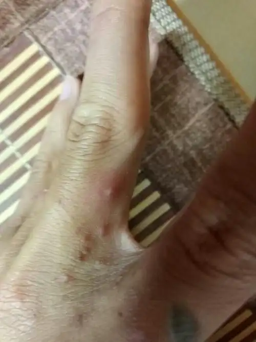 没事全身就会痒,挠一挠左边,突然右边就会痒,一直挠越挠越痒,现在手的