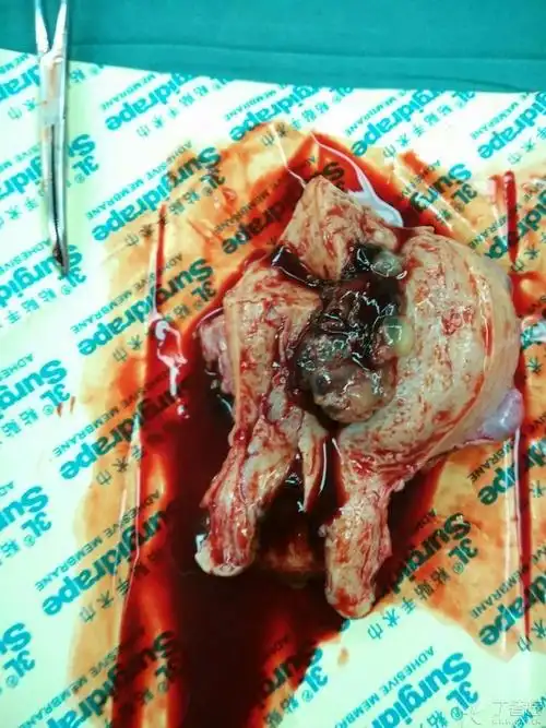 葡萄胎典型照片