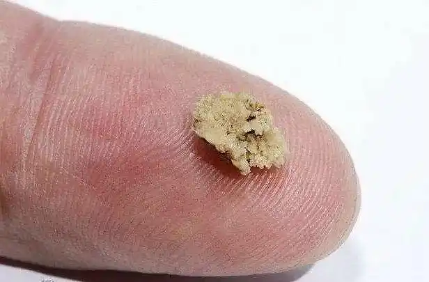 结石排出会有什么感觉?怎么做,才能让"小石子"更快排出去?