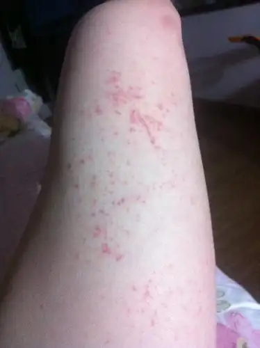 过去也有同样状况o请问是不是过敏?应该怎么