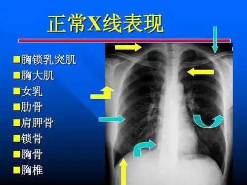 正常x 正常x线表现 胸锁乳突肌 胸大肌 女乳 肋骨 肩胛骨 锁骨 胸骨