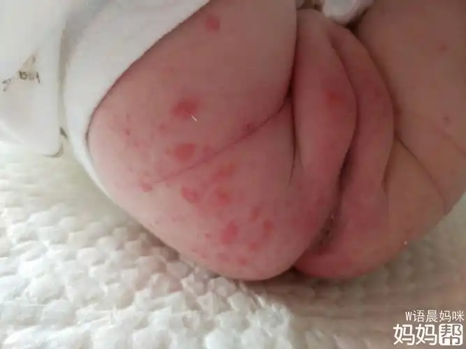 给孩子洗洗,涂点红霉素眼药膏或者护臀膏.