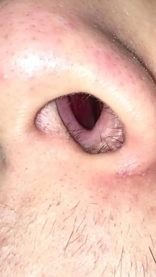 左边鼻子很塞,里面有红色东西 是什么 我有鼻炎请问大家.