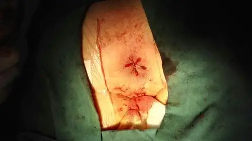 痔疮前后对比,微创源于手术艺术_照片