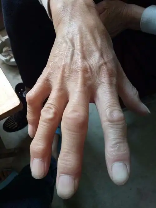 母亲56岁,手指变形疼痛2年多,有时候发麻,肿大关节,求大神看看这是