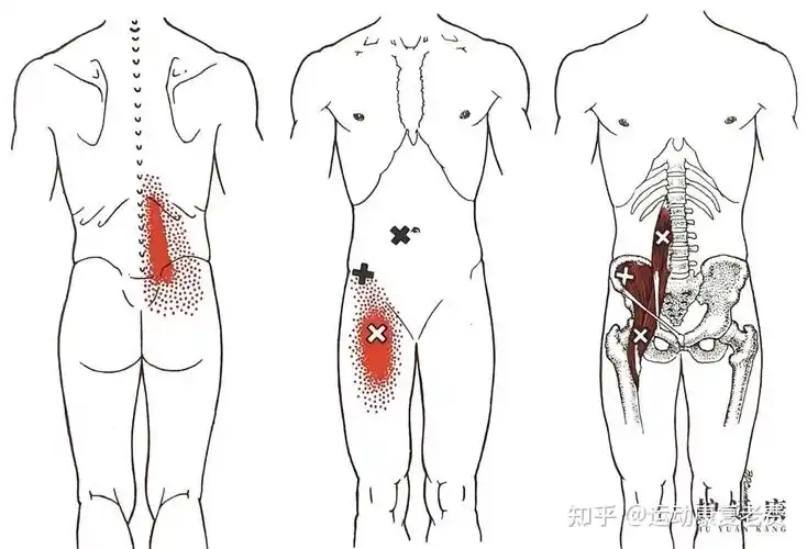 腰大肌引发腰背部脊柱的深层疼痛,沿胸椎下段延伸至骶髂关节,甚至到达