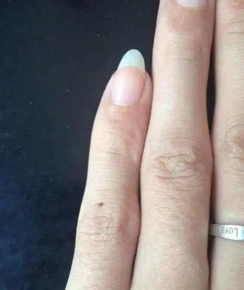 无名指有痣的女人命运