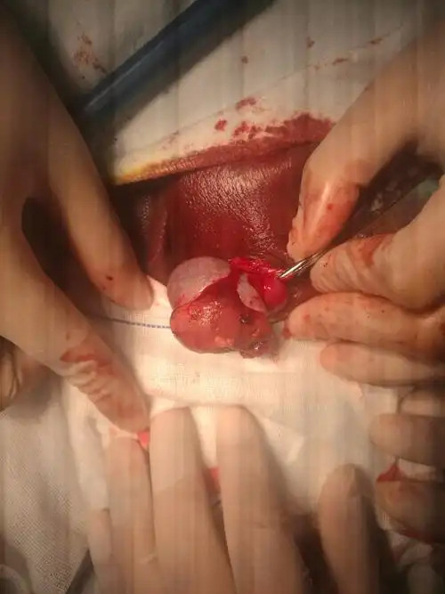 一例睾丸破裂的手术病历 - 好大夫在线