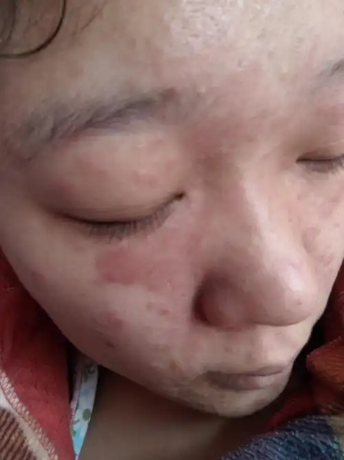 谁知道我脸上是怎么回事,脸上起皮 又干,又痒,脸上一块一块的发红,跟