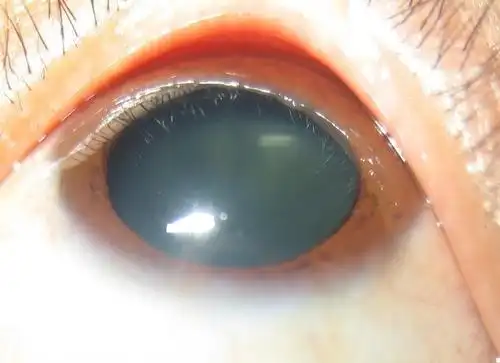 各种损伤死亡的瞳孔造成的左右瞳不等大等圆,双眼不一致,而瞳孔