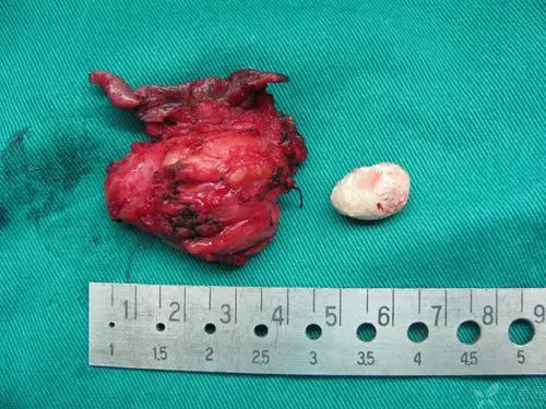 【病例讨论】你见过的下颌下腺导管结石有多大? [病例帖]