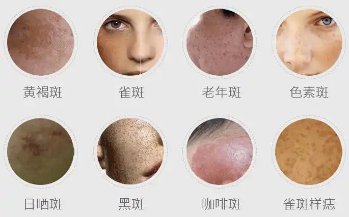 美莱专家表示色斑大致分为以下几种类型,要想有效祛斑,要先到正规的