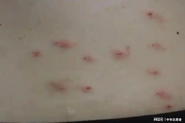 红色丘疹伴有瘙痒,疼痛丘疹性荨麻疹也是虫咬皮炎的一种,是由昆虫叮咬