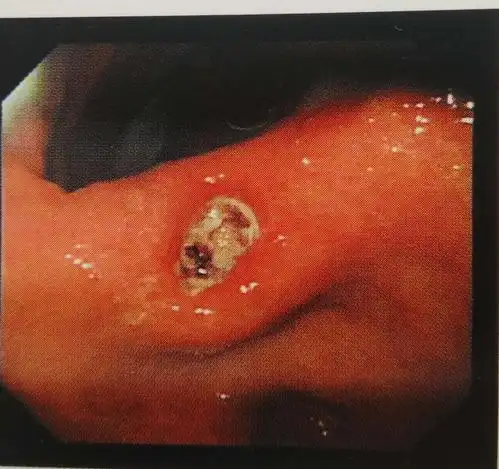 胃溃疡镜下影像