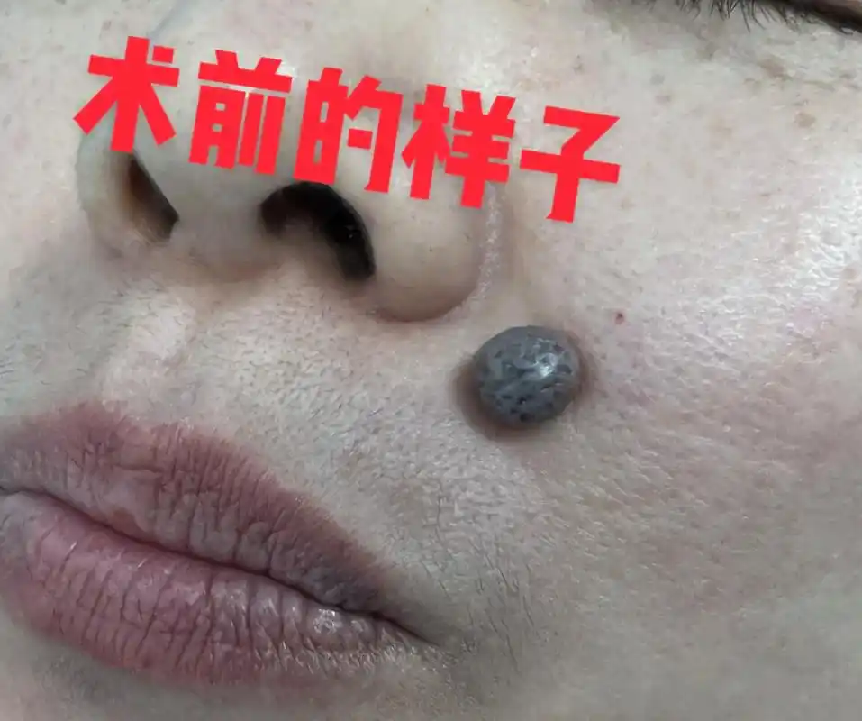 皮肤科 #皮肤问题 #色素痣 - 抖音