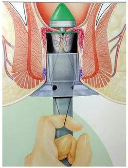 痔疮这朵盛开的菊花