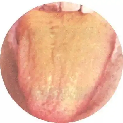 舌苔的颜色 舌苔薄白为正常舌苔或表证初起.