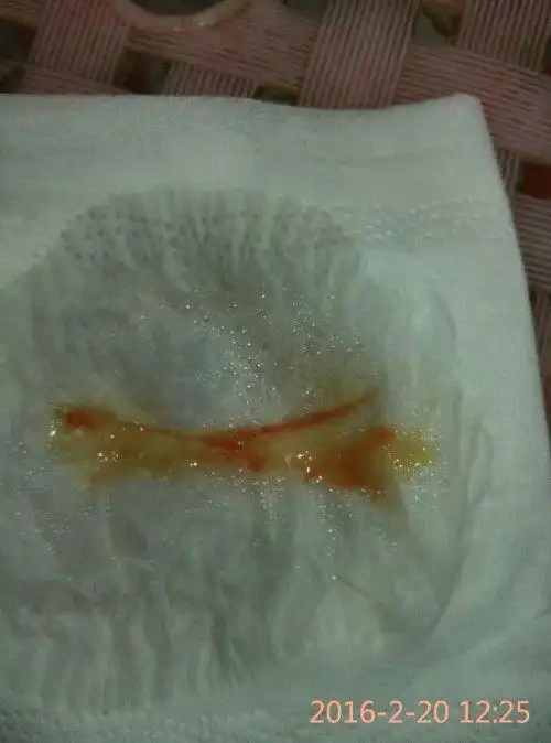 黄色的,这两天鼻涕少了变成痰,刚刚有痰粘稠带血混合一起,吐了两次都