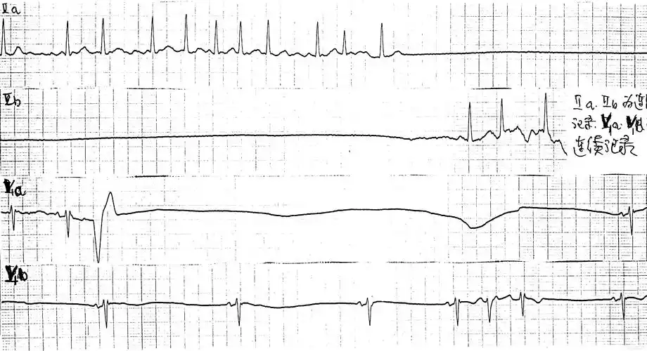 求:心电机械分离 和心室静止 的心电图图形
