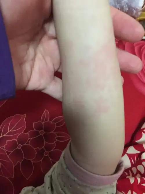 三岁孩子,胳膊跟腿内侧起了好多红色的疙瘩,孩子也没说痒痒,也没有