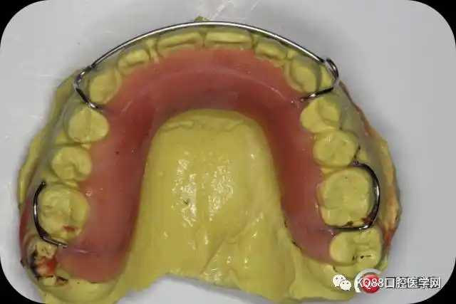 自己动手哈里氏保持器,前腭附加斜面导板.