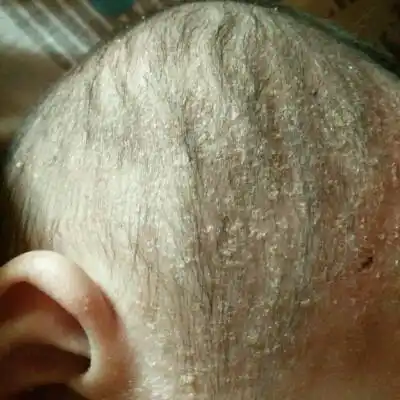 宝宝头皮上长的类似於头皮屑,查了药膏也不管用,有什麼好的方法?