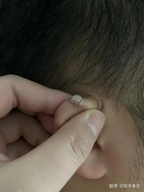 耳朵上长了一个肉疙瘩