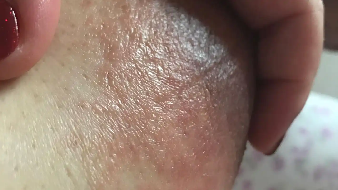 我正处于哺乳期,最近两个月,孩子把乳头咬破了,乳头有皴裂,天天要在