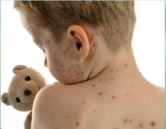 其它 桐木镇旺旺幼儿园冬季传染疾病预防知识 写美篇    主要症状