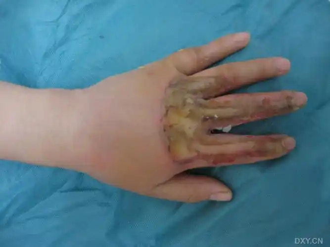 【 求助】一例手热压伤创面如何修复? [病例帖]