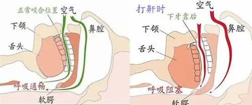 打呼噜是因为上气道从鼻腔一直到喉腔,一直到声门,出现了一些狭窄