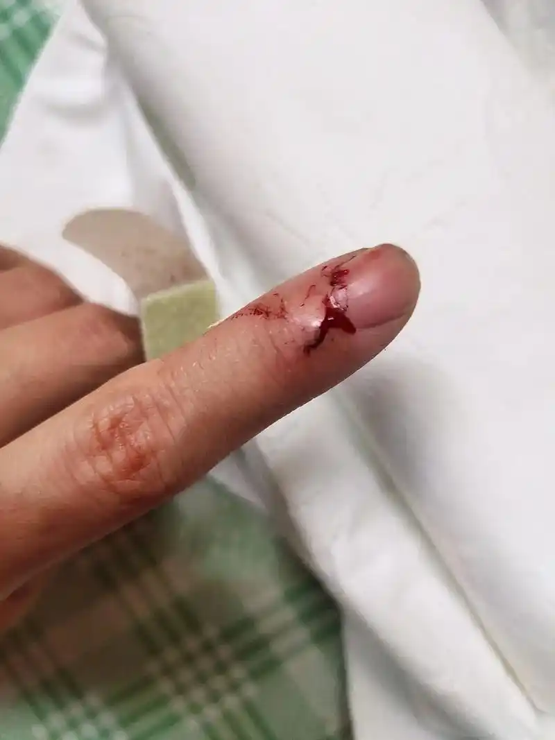 分享一下缝纫机扎手的恢复过程