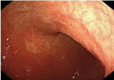 慢性萎缩性胃炎_介绍_发病原因 - 好大夫在线