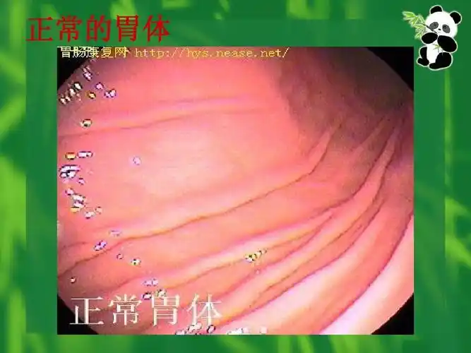 正常的胃体
